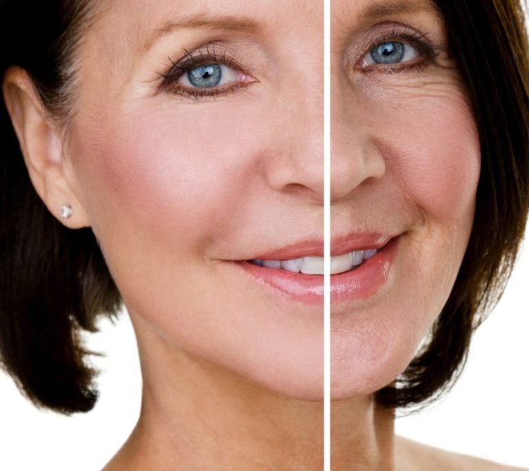 Mini lifting visage Tunisie : lifting soft Tunisie - mini lifting prix