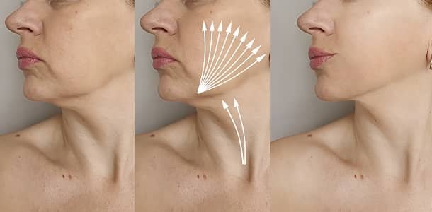 Thread-Lift