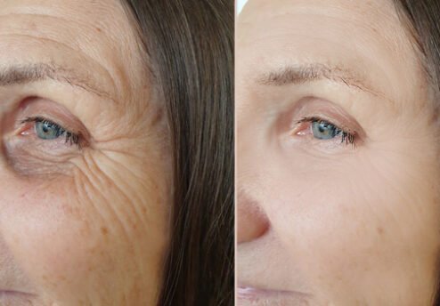 lifting-visage-sans-cicatrices