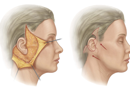 Deep-Plane-Facelift