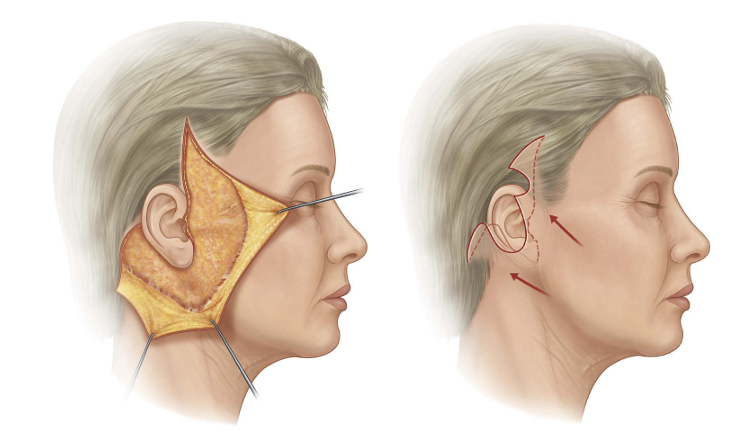Deep-Plane-Facelift