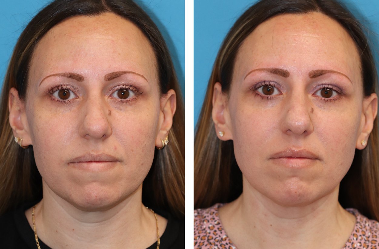 Quantum-RF-Facelift-avant-après